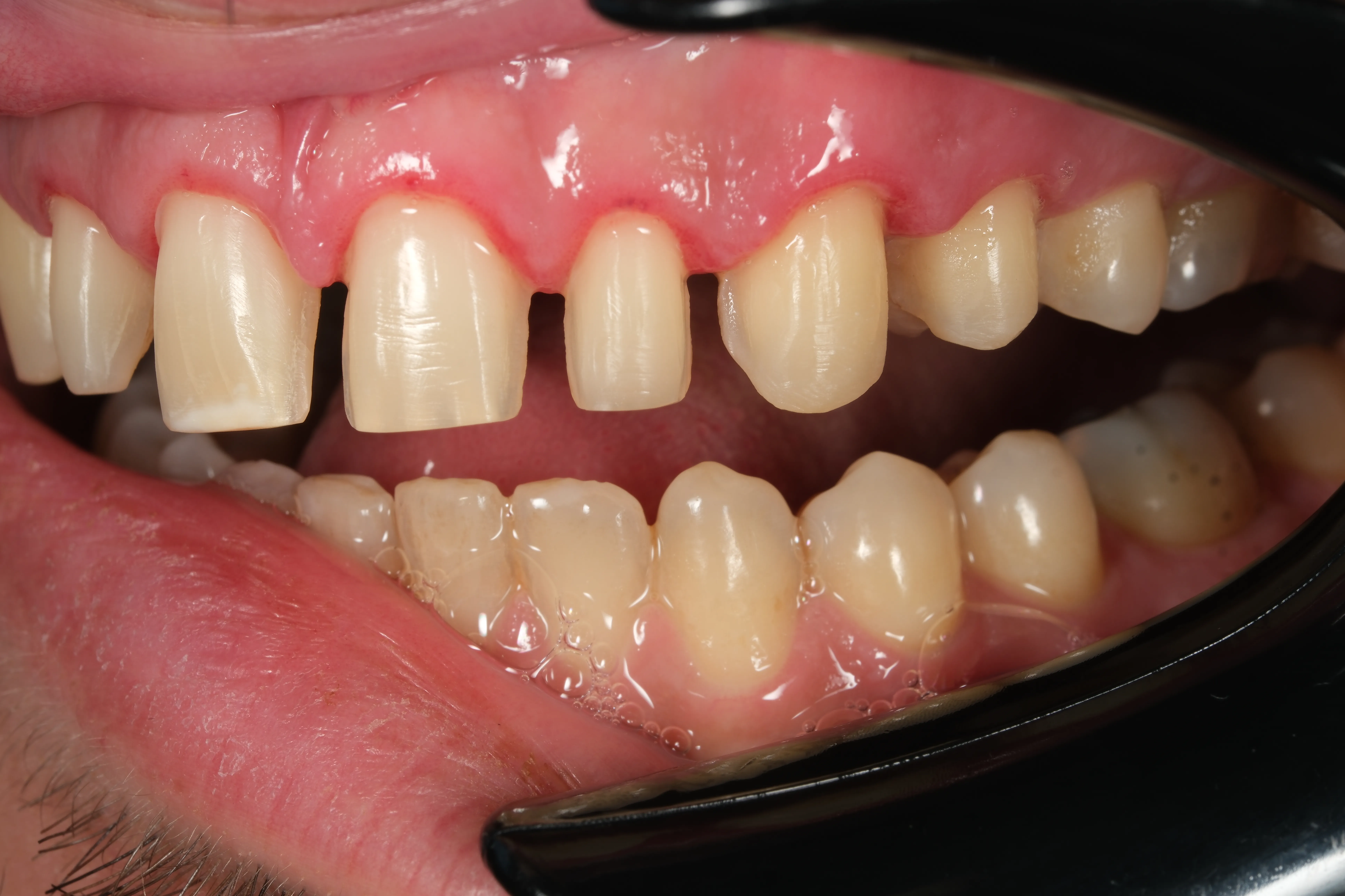 Diş Eti Tedavisi (Periodontoloji)