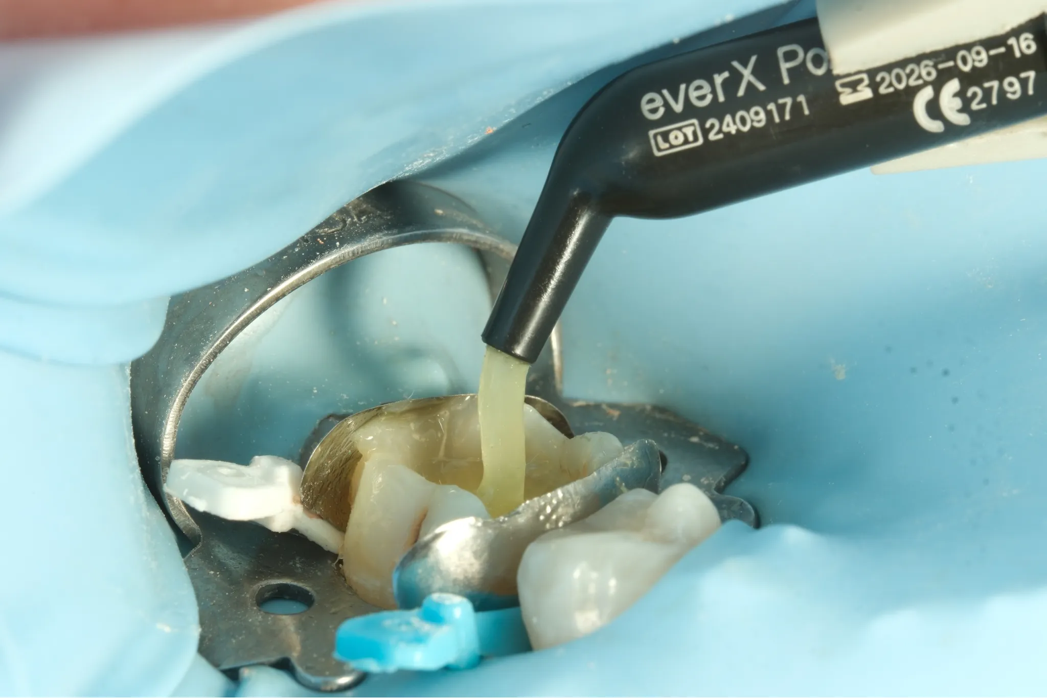 Estetik Dolgu Tedavisi